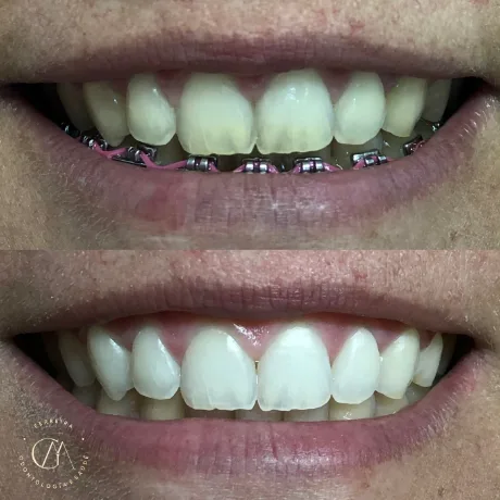 Clareamento dental