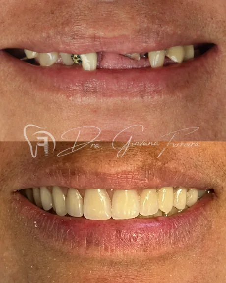 Implante dentário