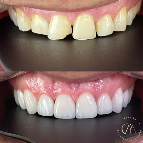 Lentes de contato dental