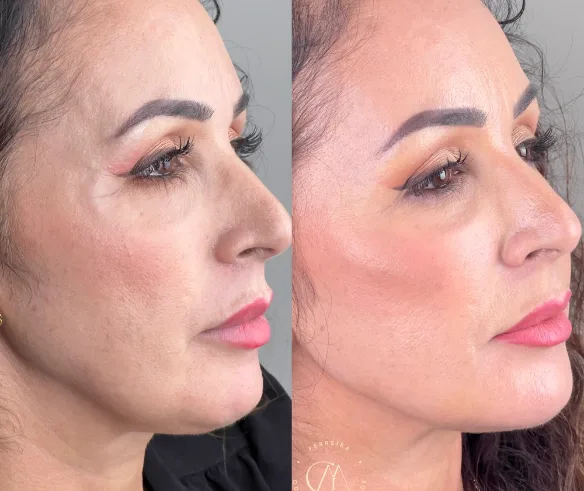 Preenchimento facial