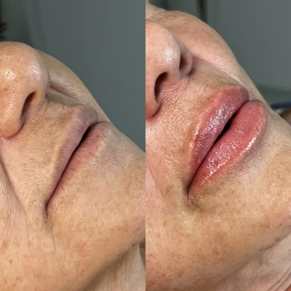 Preenchimento labial