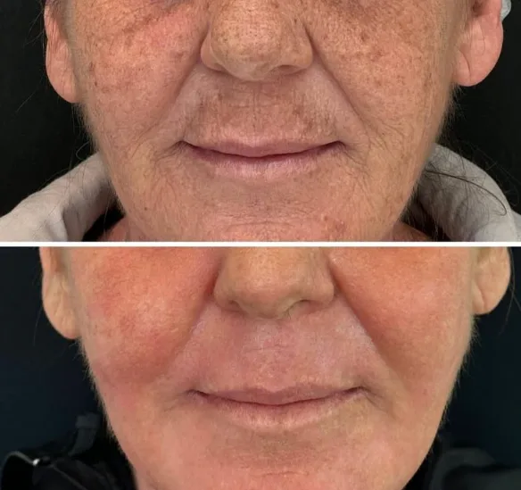 Skincare e peeling