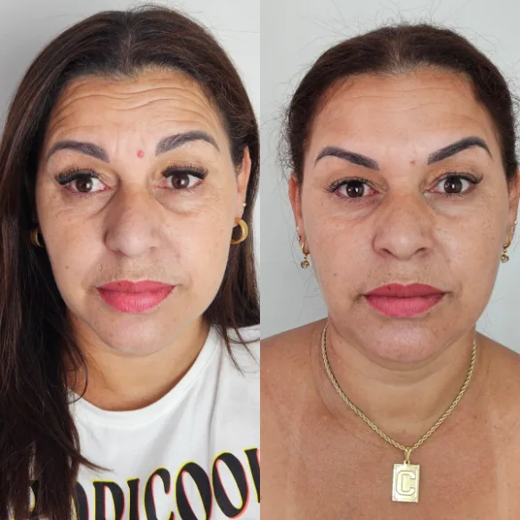 Toxina botulínica